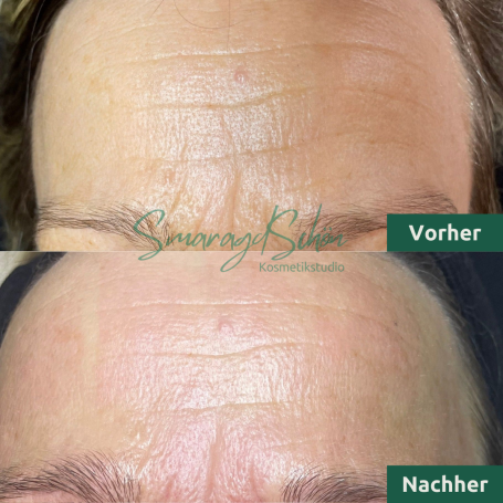 Microneedling bei SmaragdSchön