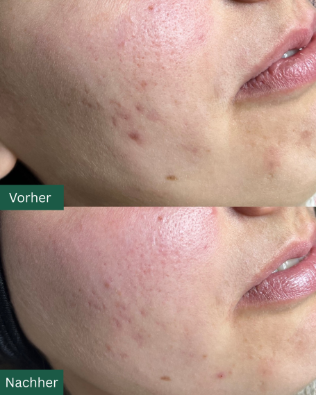 Fruchtsäure & Microneedling