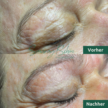 Microneedling bei SmaragdSchön